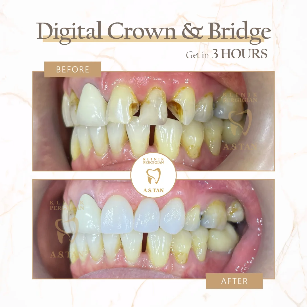 Crown Treatment