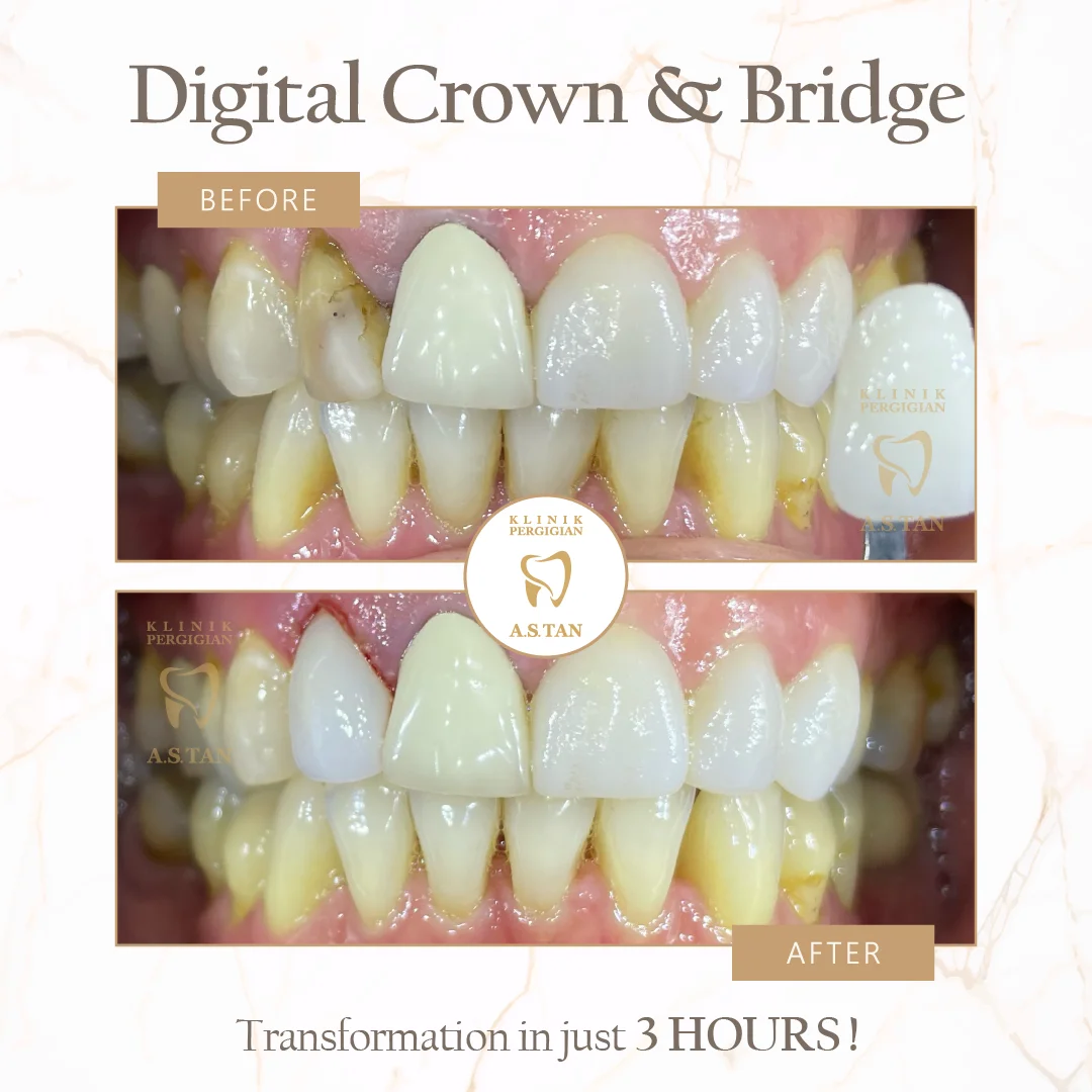 Crown Treatment