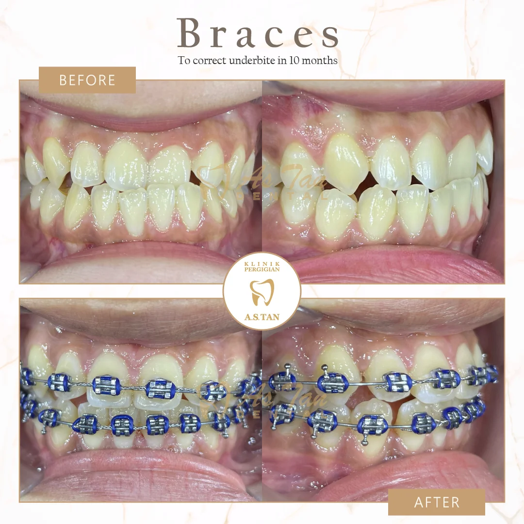 Braces Treatment Success