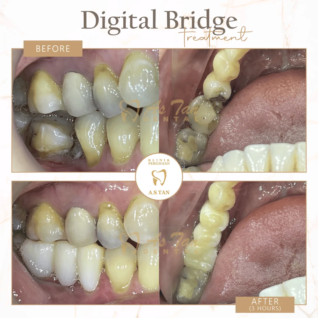 Bridge Restoration