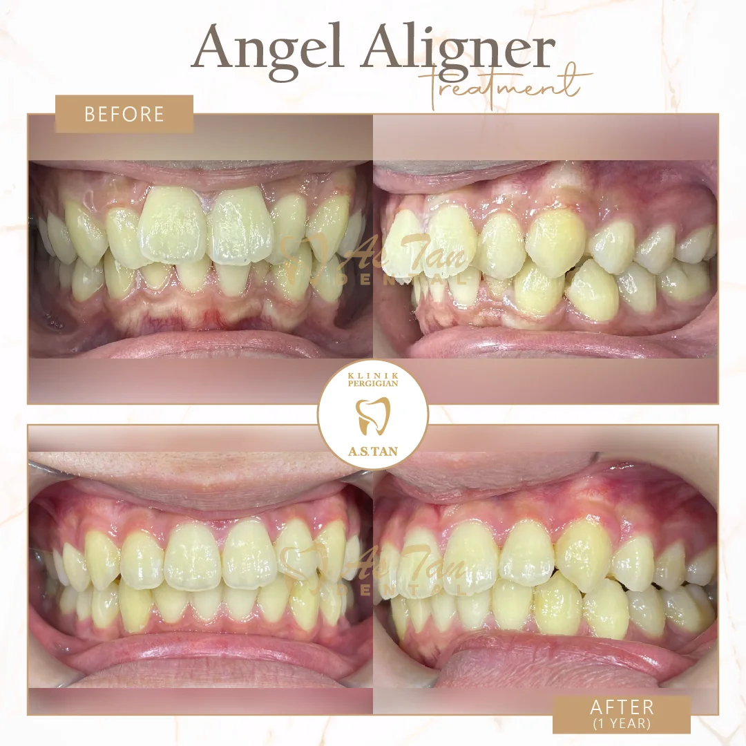 Angel Aligner - Front & Side View