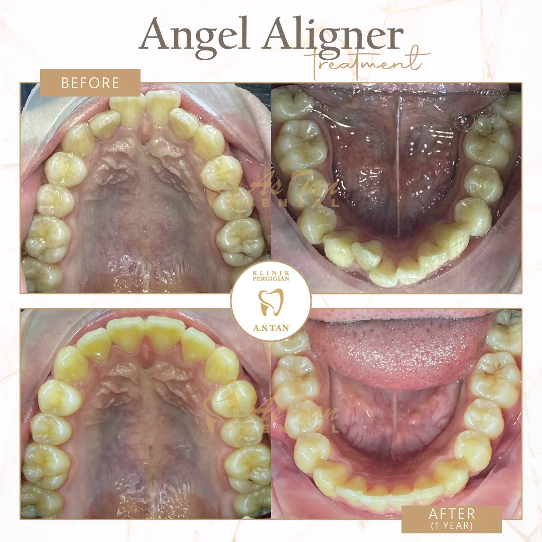 Angel Aligner - Interior View